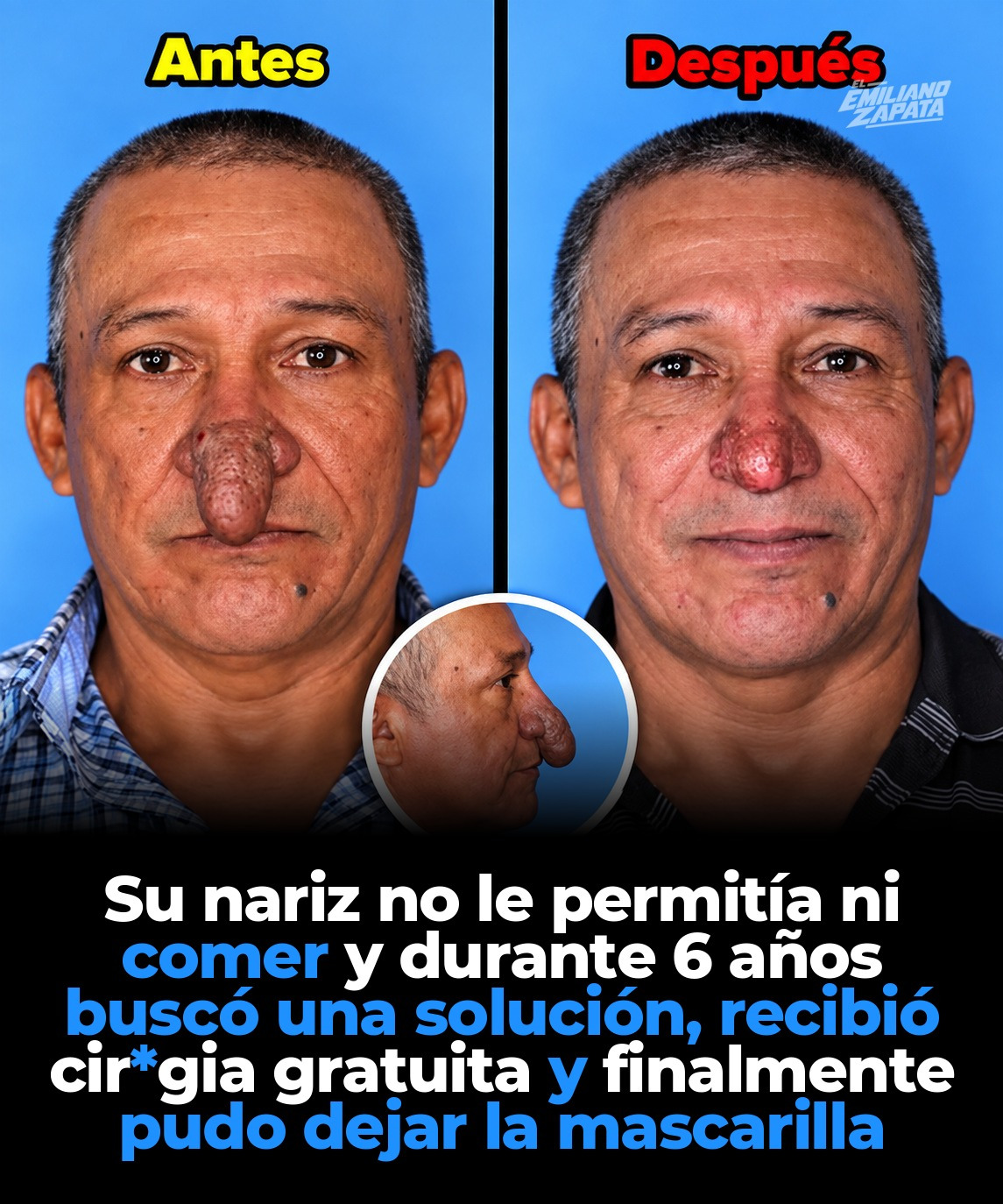 Pintaba la casa de un cirujano y él le operó gratis la nariz que no lo dejaba comer