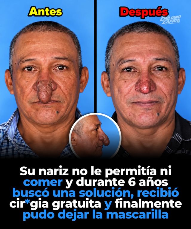 Pintaba la casa de un cirujano y él le operó gratis la nariz que no lo dejaba comer